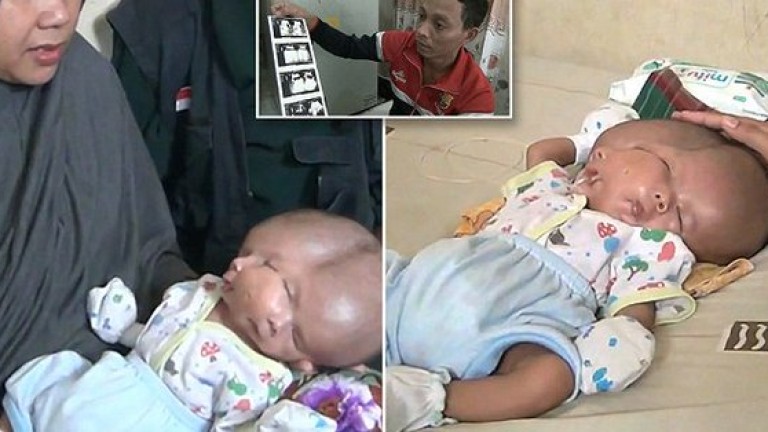 В Индонезия се роди бебе с две лица