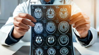 В последните години болестта на Алцхаймер е една от най коментираните