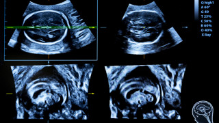 Жена в Бразилия роди първото в света бебе от утроба