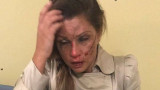 БРУТАЛНО: Шведското гадже на Сани Алекса я преби (СНИМКИ)