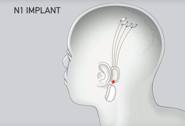 Илюстрация на имплантите против шизофрения и аутизъм