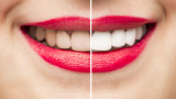 Бели или жълти зъби - професионално избелване и грижи или просто генетика
