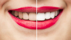 Защо някои хора имат по-бели зъби от останалите