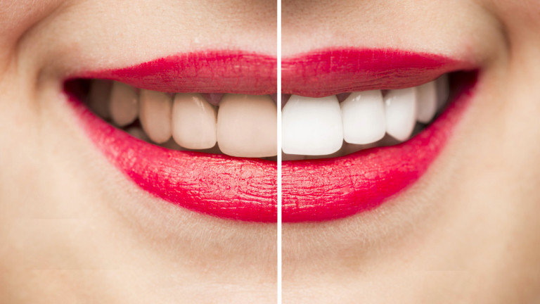 Снимка: Защо някои хора имат по-бели зъби от останалите