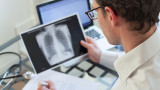 Над 4000 българи годишно заболяват от рак на белия дроб 
