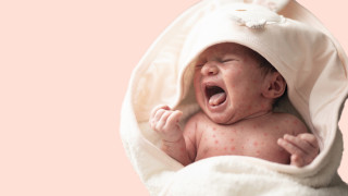 Морбилите нарастват, заболелите области се увеличават