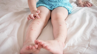 Регистрираха 24 нови случая на варицела във Великотърновско само за седмица