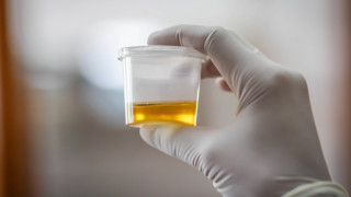 В Япония изпитват първия тест в света за установяване на рак чрез проби урина