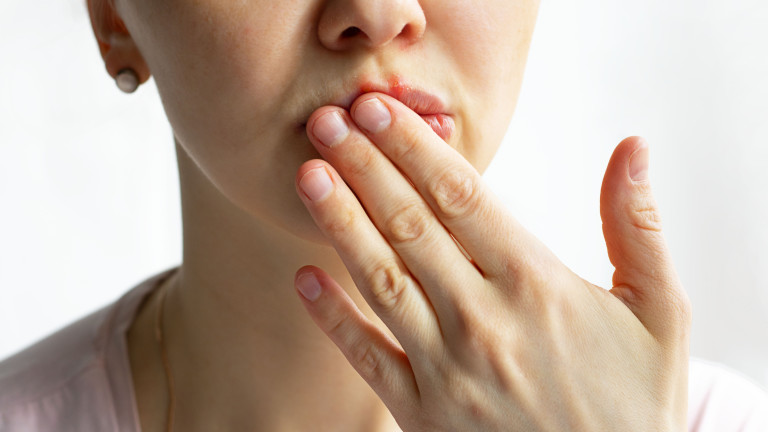 Напуканите устни са чест проблем на почти всички през зимата.