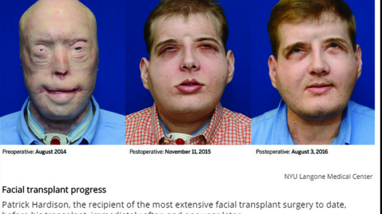 Какво се случва с мъжа с трансплантираното лице?
