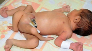 ШОК! В Пакистан се роди бебе с шест крака (12+)