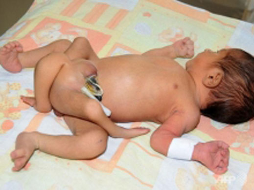 ШОК! В Пакистан се роди бебе с шест крака (12+)