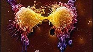 Откриха нови гени, отговорни за рака на гърдата
