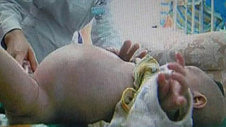 2-годишно бебе роди паразитния си брат