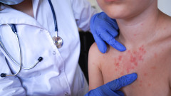 Морбили: какво трябва да знаем за една &bdquo;забравена&ldquo; болест, която се завръща