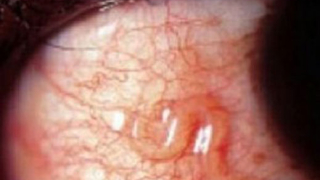 Лекар извади от окото на индиец 13-сантиметров червей