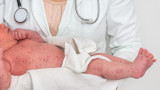  Епидемиолог: От години нямаме 95% покриваемост на имунизация от морбили 