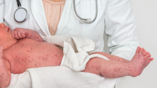 Епидемиолог: От години нямаме 95% покриваемост на ваксинация от морбили