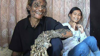 Човек-дърво в Индонезия!