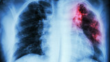 Безплатни прегледи за туберкулоза, растеж на пациенти след пандемията 