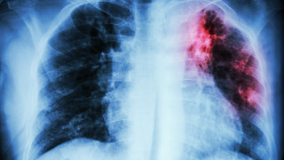 Безплатни прегледи за туберкулоза, ръст на пациенти след пандемията