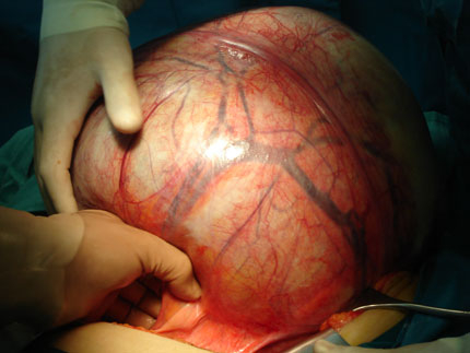 Хирурзи извадиха 20 кг тумор от корема на варненка 