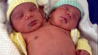 Бебе с две глави се роди в Бразилия