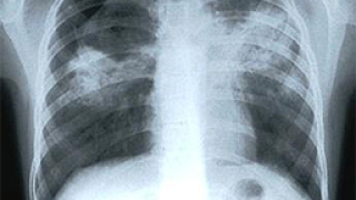 Нови случаи на туберкулоза в Ямболско