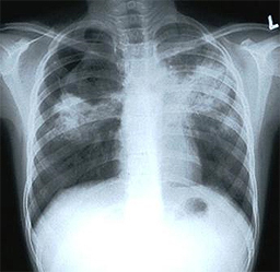 СЗО призовава нациите да засилят борбата срещу туберкулозата