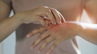 Около 200 000 възрастни в България боледуват от атопичен дерматит
