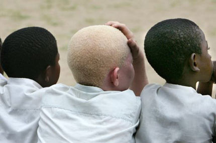 В Танзания забраниха знахарството, за да спрат нападенията срещу албиноси