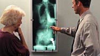 Над 300 000 българи страдат от остеопороза 