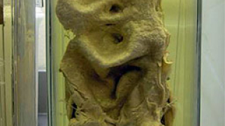 40 арестувани за търговия с органи в Турция