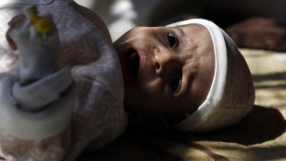 Половината деца под 5-годишна възраст в Йемен тежко недохранени