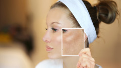 Как да се справим с хиперпегментацията на кожата