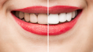 Как да имаме по-бели зъби
