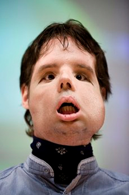 Испанец с ново лице след 5 години агония