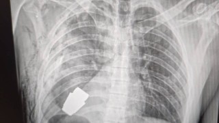 Лекари извадиха невзривена граната от гърдите на украински войник съобщава