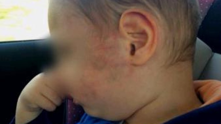 2-годишно дете със синини след детска градина