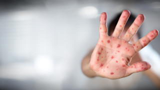 Сърбия е заплашена от епидемия от шарка*, ако децата не бъдат ваксинирани