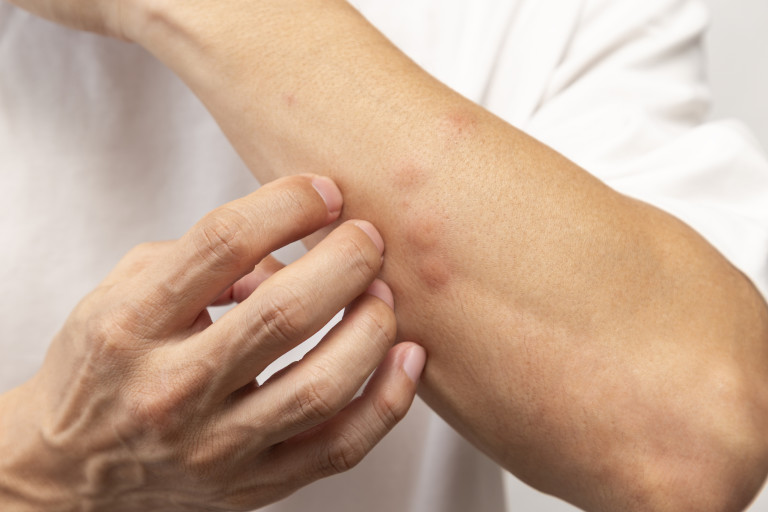 Сърбеж, зачервяване, подуване - ухапванията от комари не са никак приятни