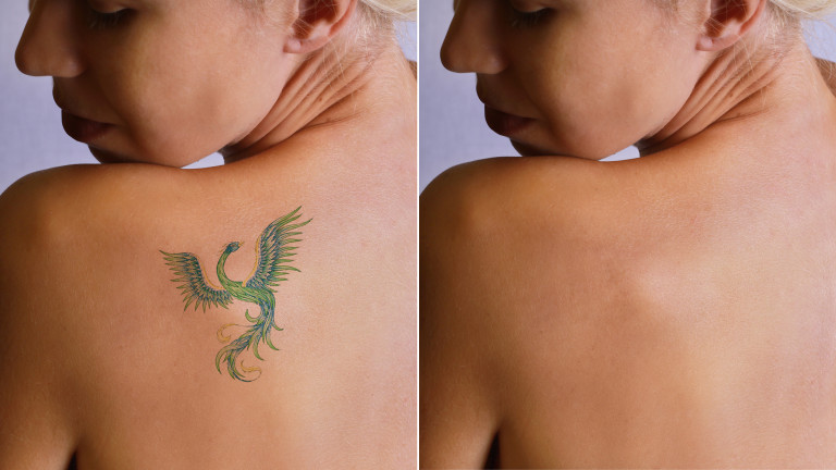 Премахване на татуировки с лазер - за и против