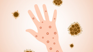 Европа остава в епицентъра на глобалното избухване на маймунска шарка