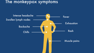 В България няма епидемия от маймунска вариола Възможно е да